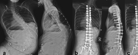 Это изображение имеет пустой атрибут alt; его имя файла - SpinalMuscularAtrophy.jpg