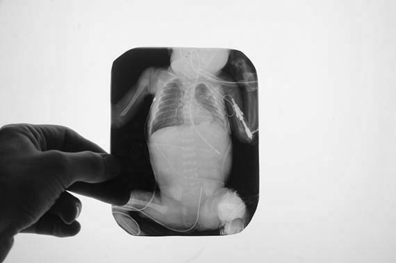 Рентген новорожденного ребенка