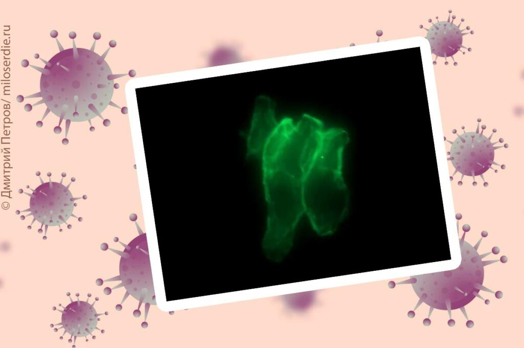 Коллаж. Флуоресцентное изображение микросгустка крови у больного с COVID-19 при 40-кратном увеличении