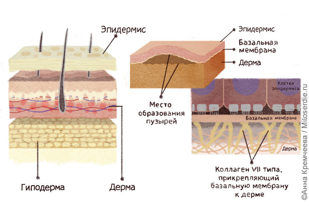 Рисунок. Буллезный эпидермолиз