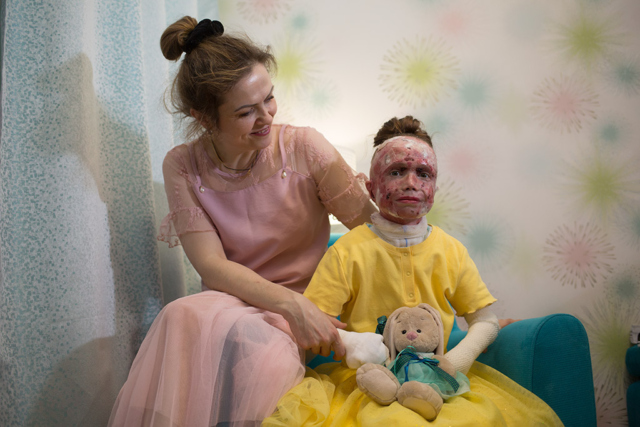 Девочка буллезным эпидермолизом