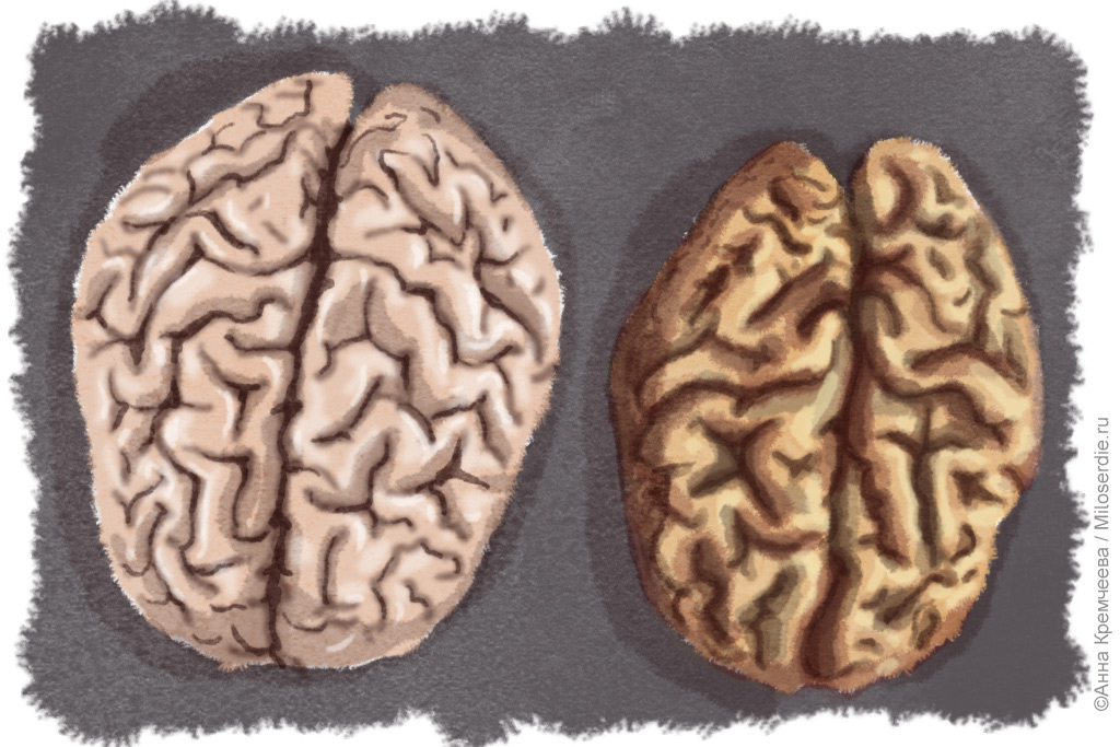 Рисунок. Деменция