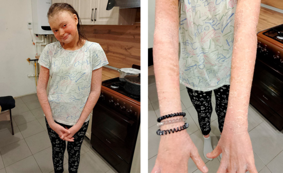 Девочка с ихтиозом