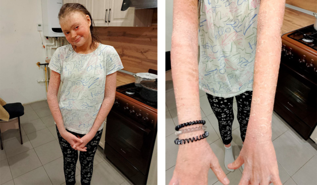 Девочка с ихтиозом