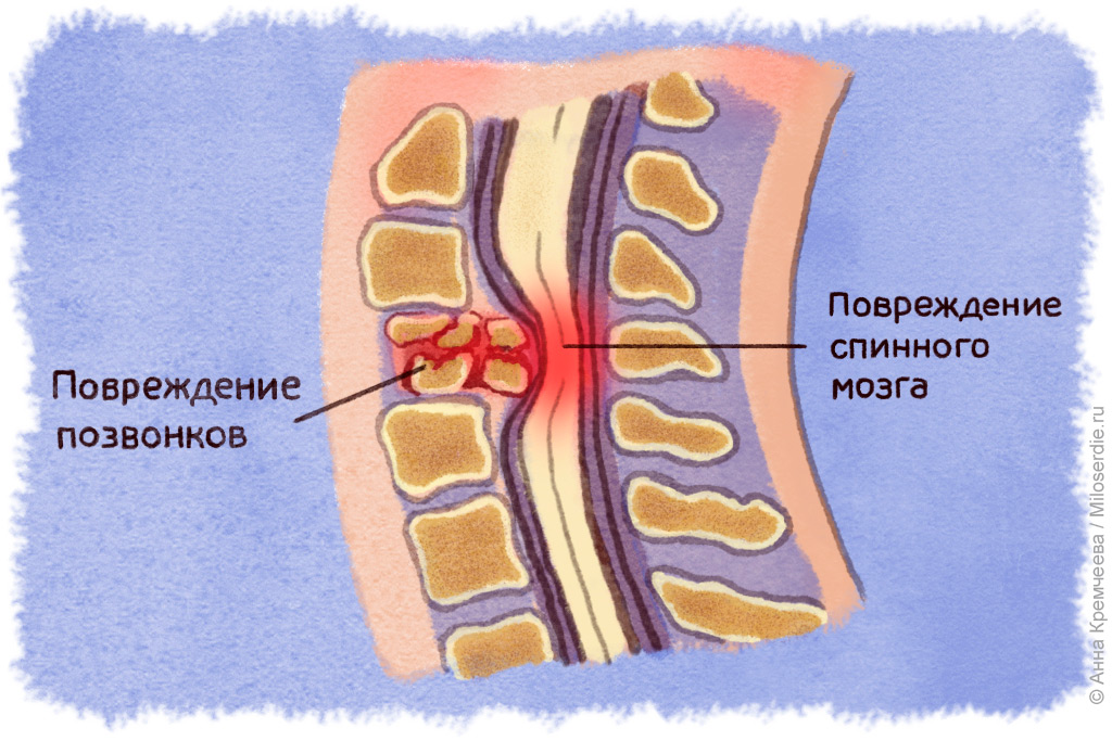 Рисунок. Травма позвоночника 