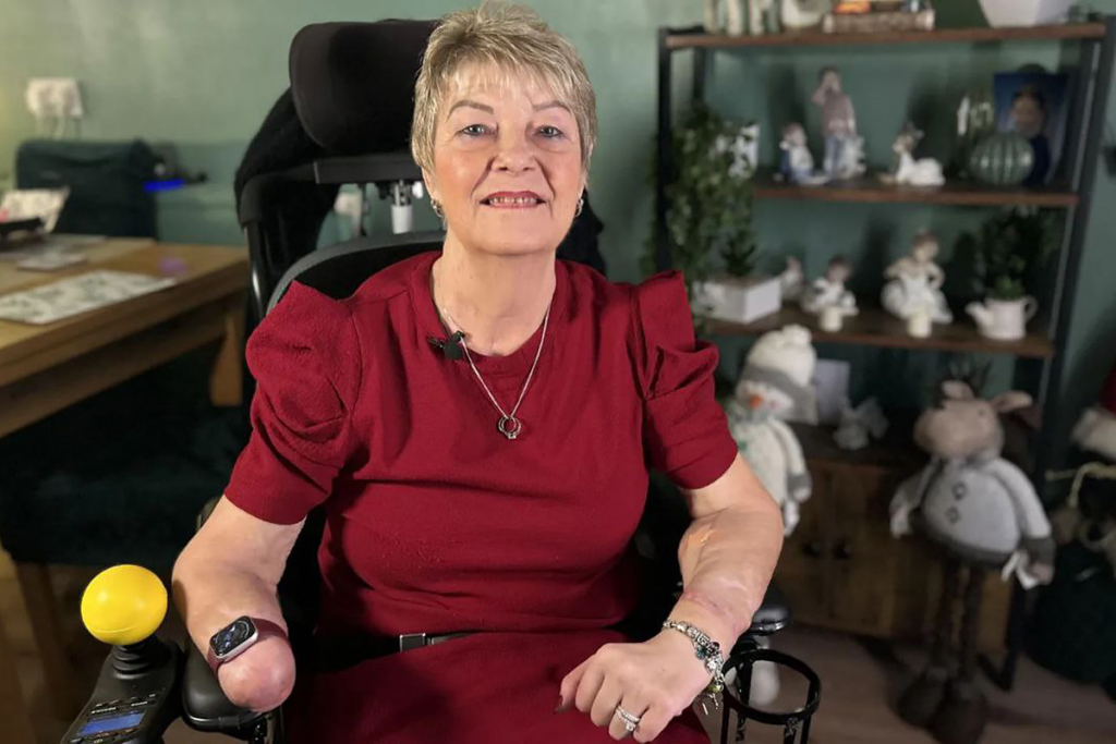 Женщина в инвалидной коляске с ампутированной кистью