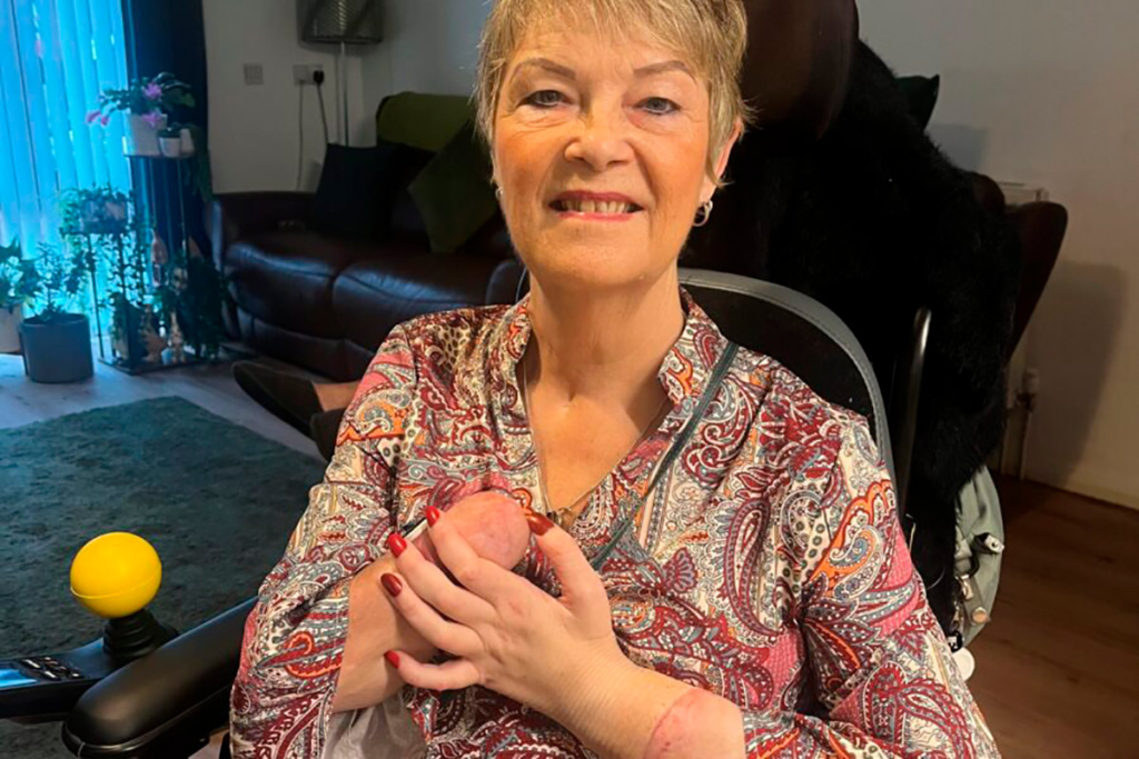 Женщина в инвалидной коляске и пересаженной рукой 