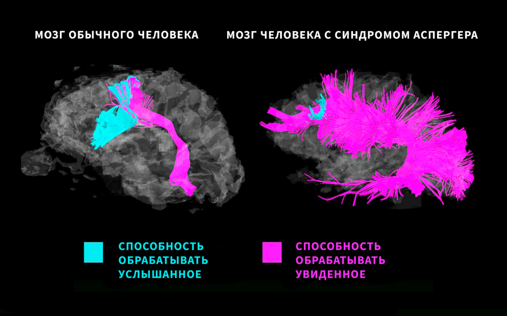 Мозг при синдроме Аспергера и обычный мозг. Изображение создано на основе Изображение основано на исследовании доктора Уолтера Шнайдера из Питтсбургского университета. Фото cyndimccoy/ commons.wikimedia.org