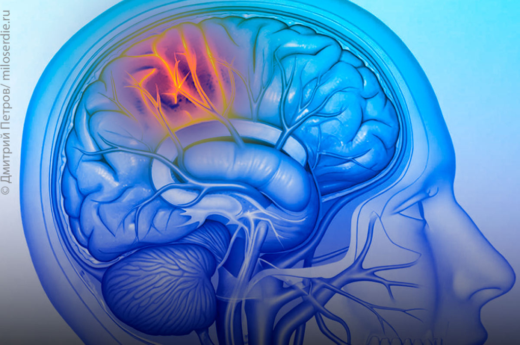 Коллаж. Тихий инфаркт