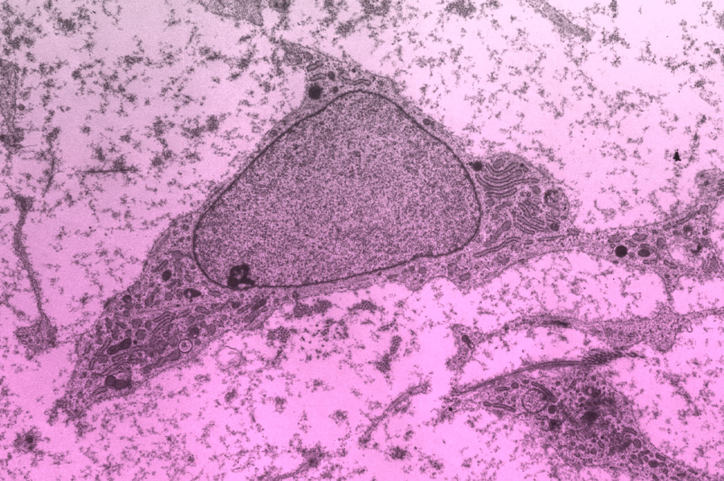 Коллаж. Лечение стволовыми клетками. Мезенхимальная стволовая клетка под электронным микроскопом