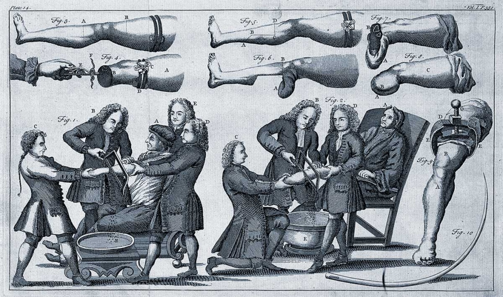 Ампутация руки и ноги. Гравюра Франческо Сезони. Италия, 1749 год. Фото: Wellcome Library, London